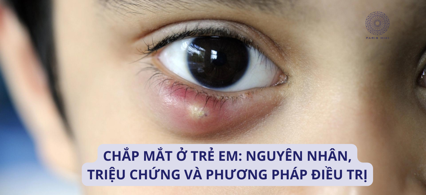 Chắp mắt ở trẻ em: Nguyên nhân, triệu chứng và phương pháp điều trị