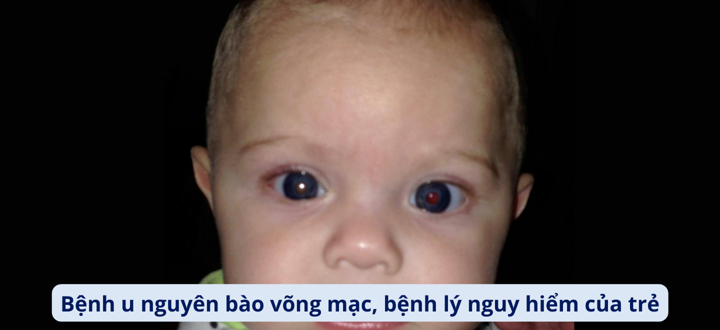 Bệnh u nguyên bào võng mạc, bệnh lý nguy hiểm của trẻ